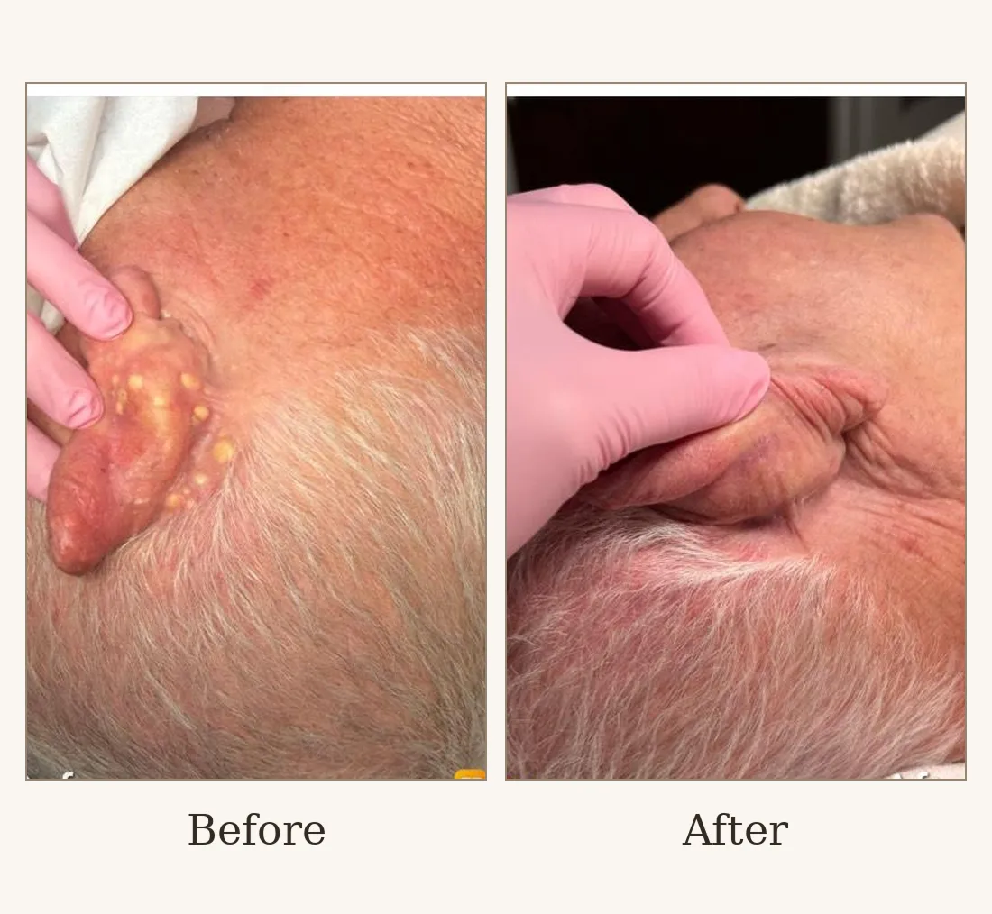 Whitehead Extraction
