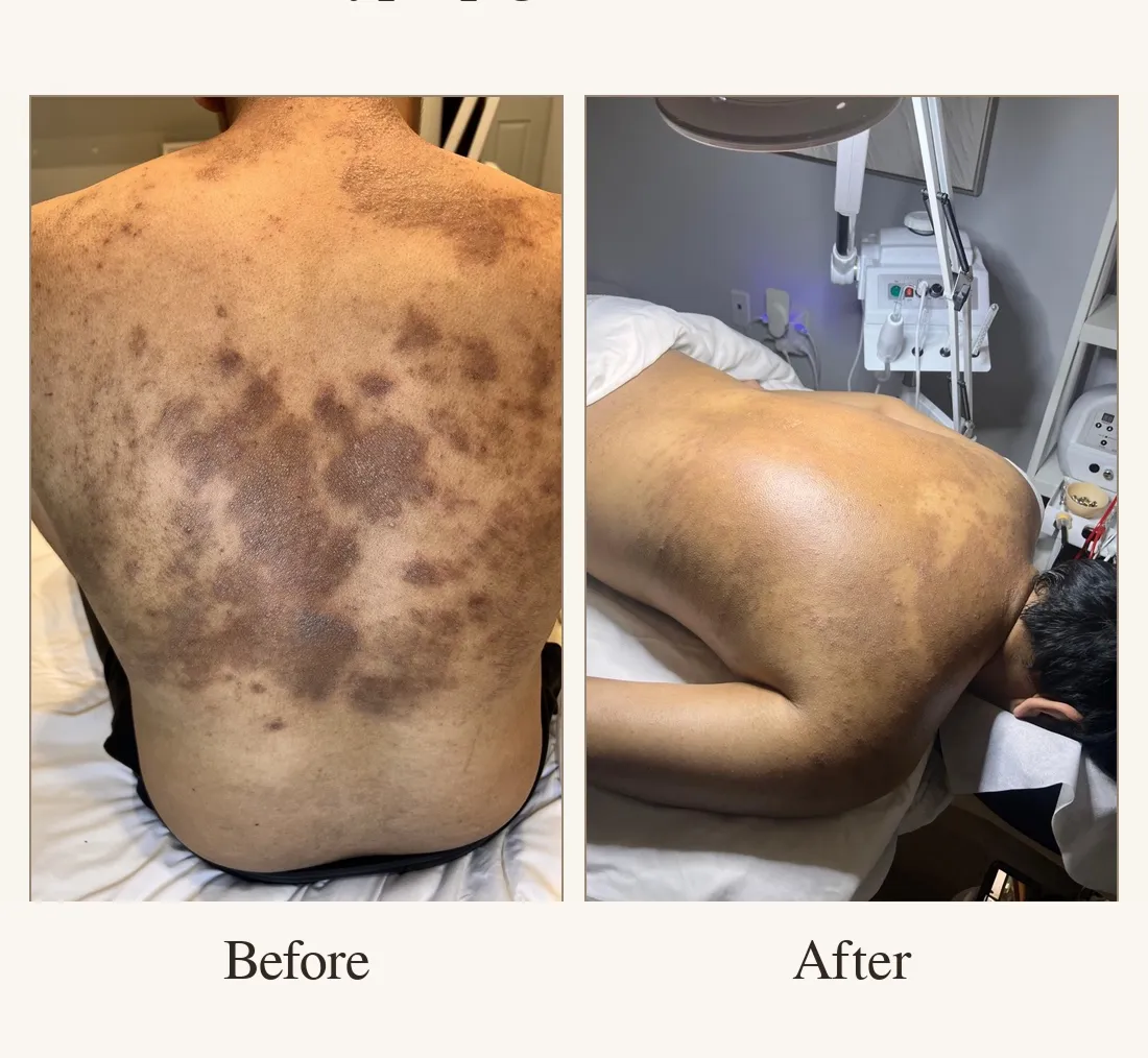 Back Hyperpigmentation