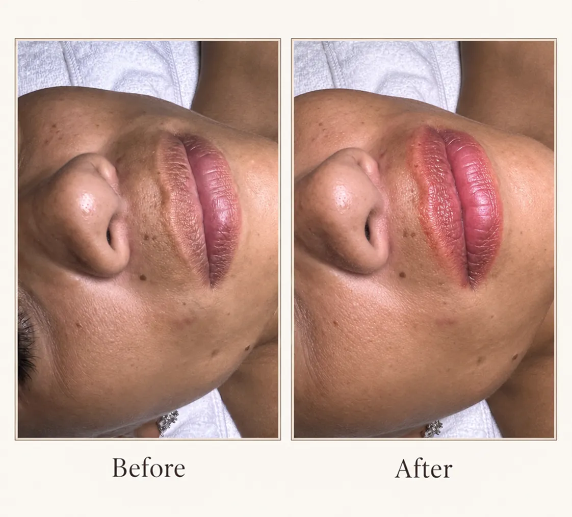 Lip Rejuvenation