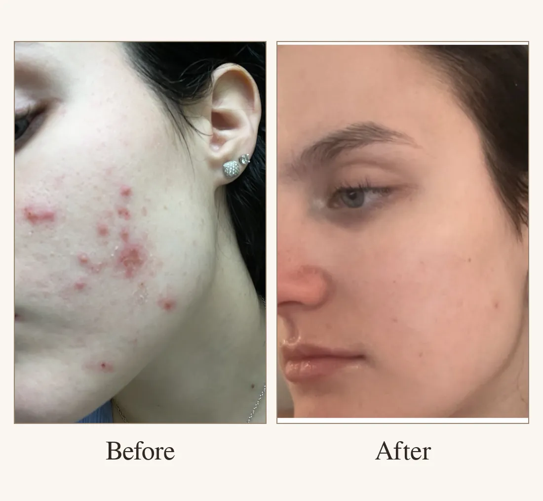 Cystic Acne