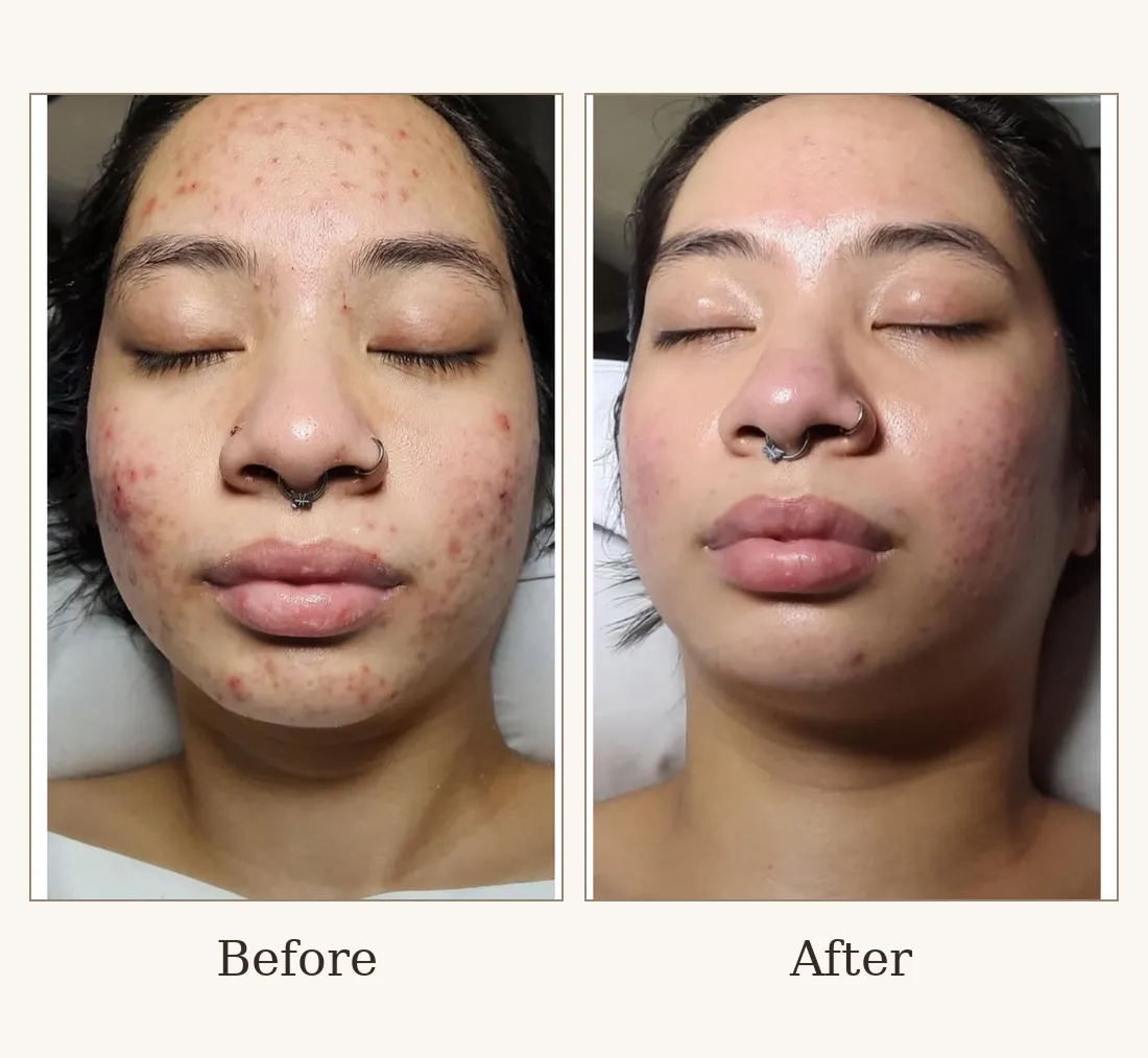 Cystic Acne