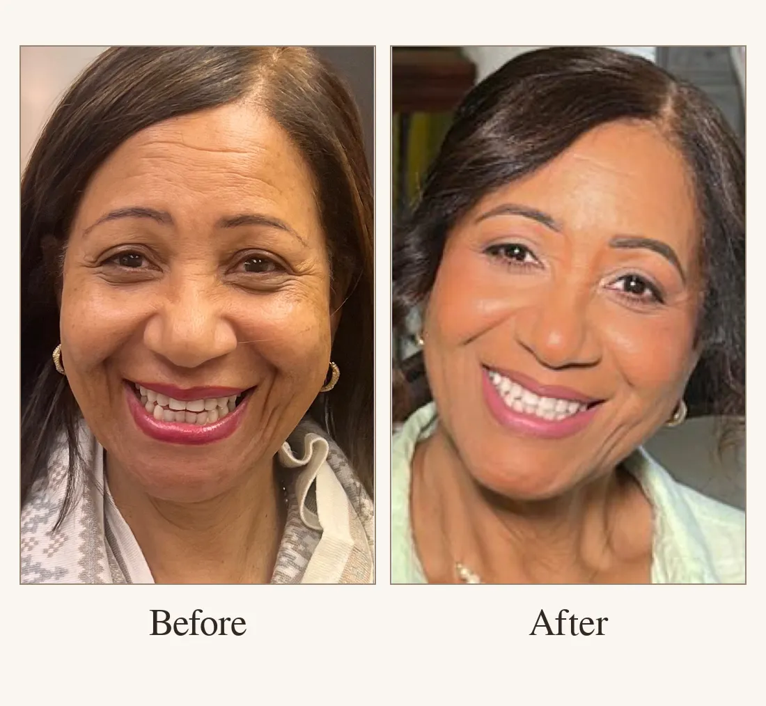Before and after: Woman's smile before and after cosmetic dentistry